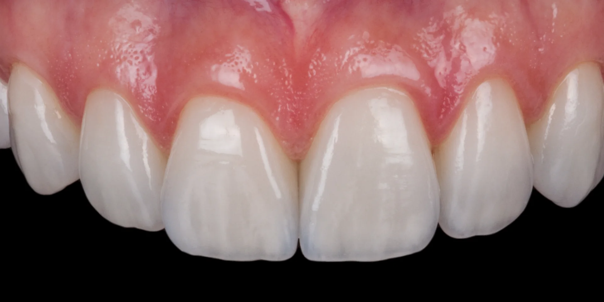 Anterior restoration presented by YM Prestige