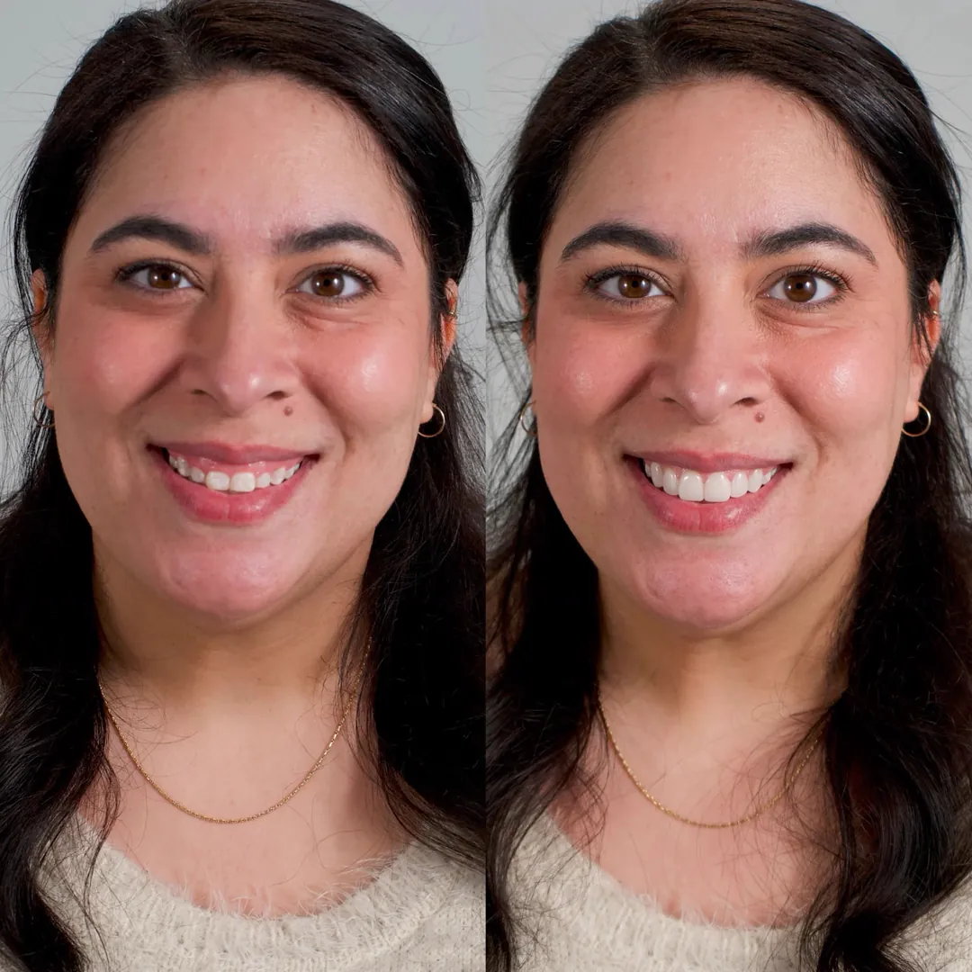 Patient before and with a Smilewear preview