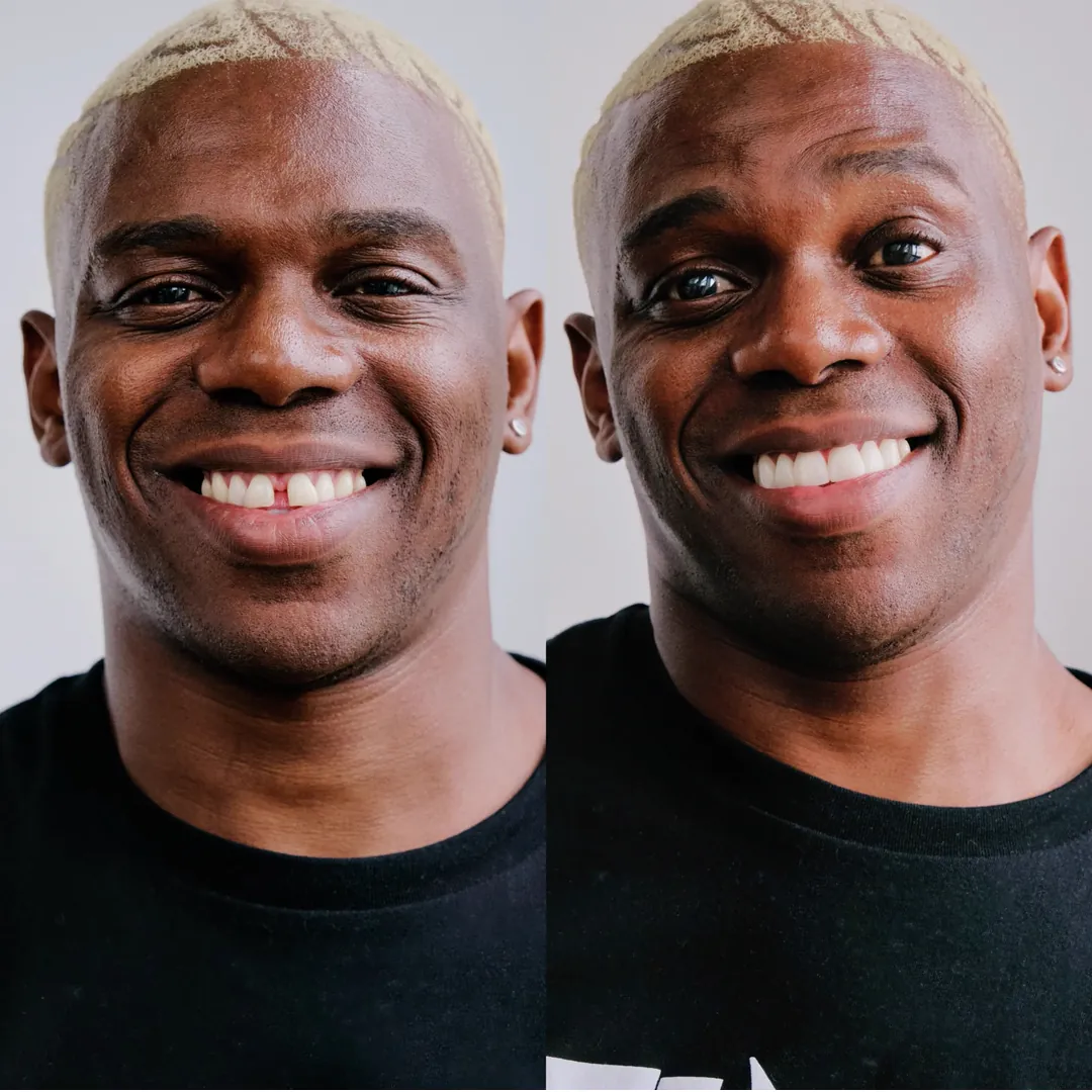 Patient before and with a Smilewear preview