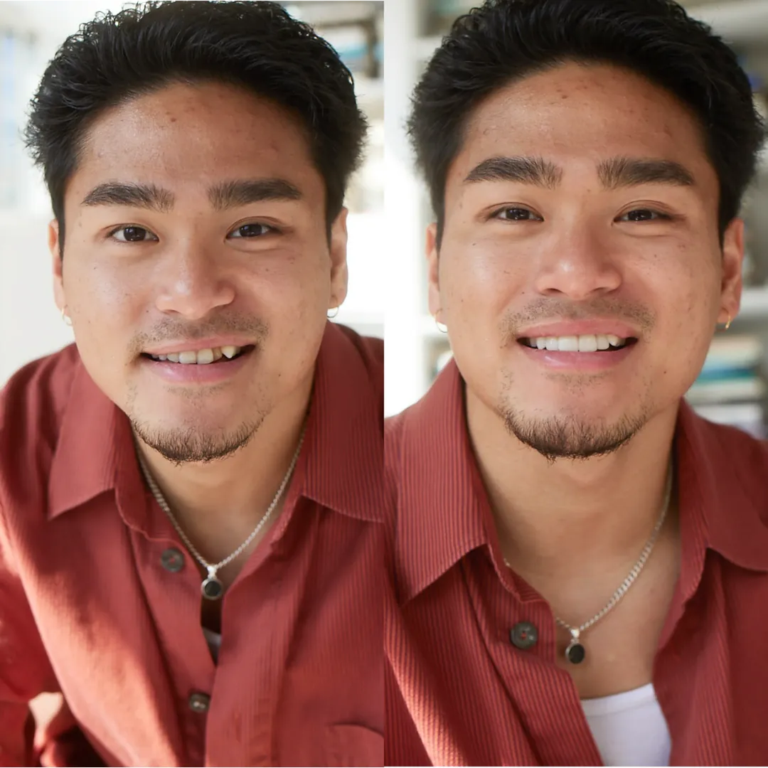 Patient before and with a Smilewear preview
