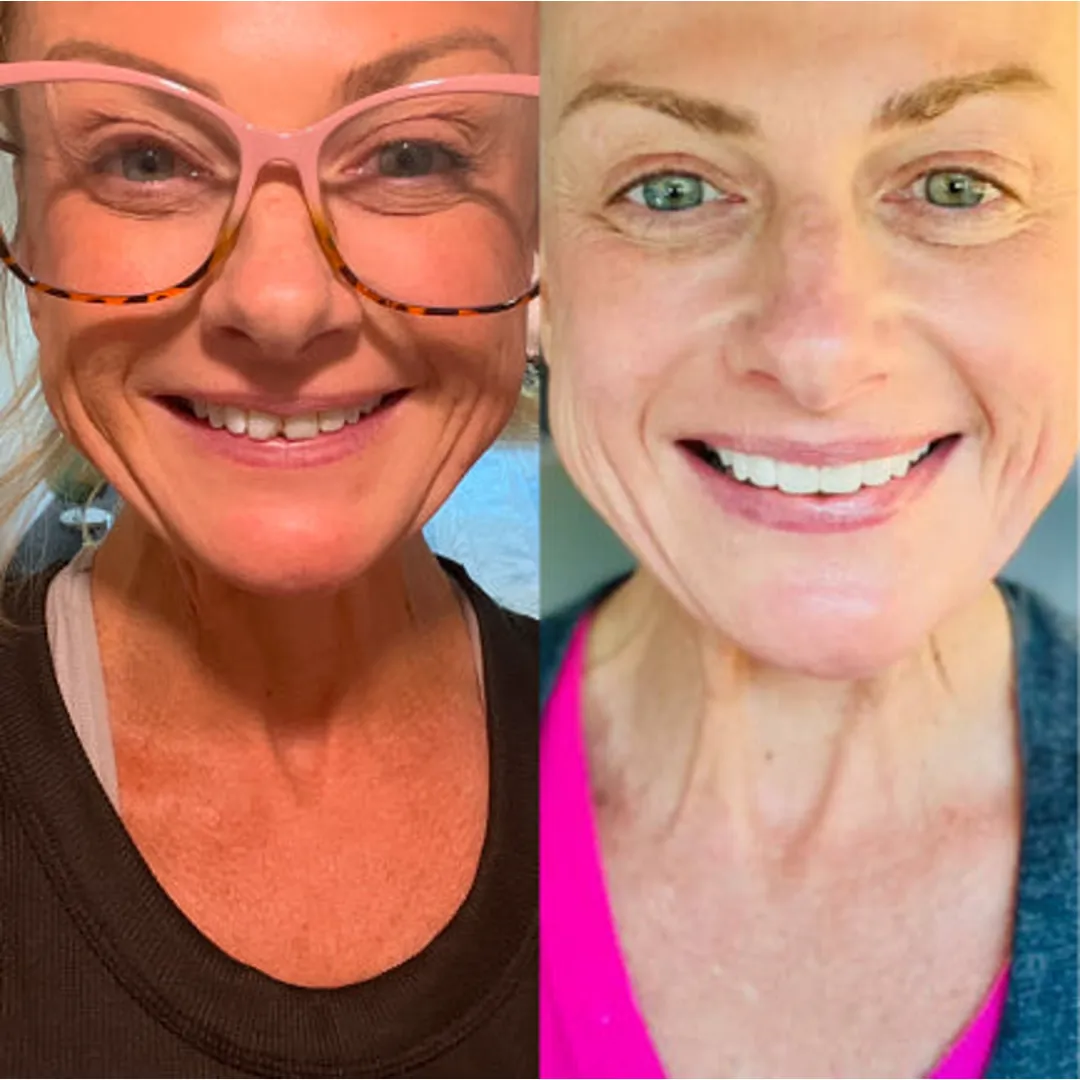 Patient before and with a Smilewear preview