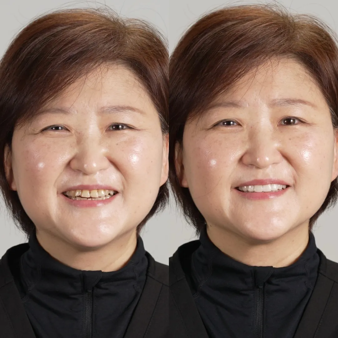 Patient before and with a Smilewear preview