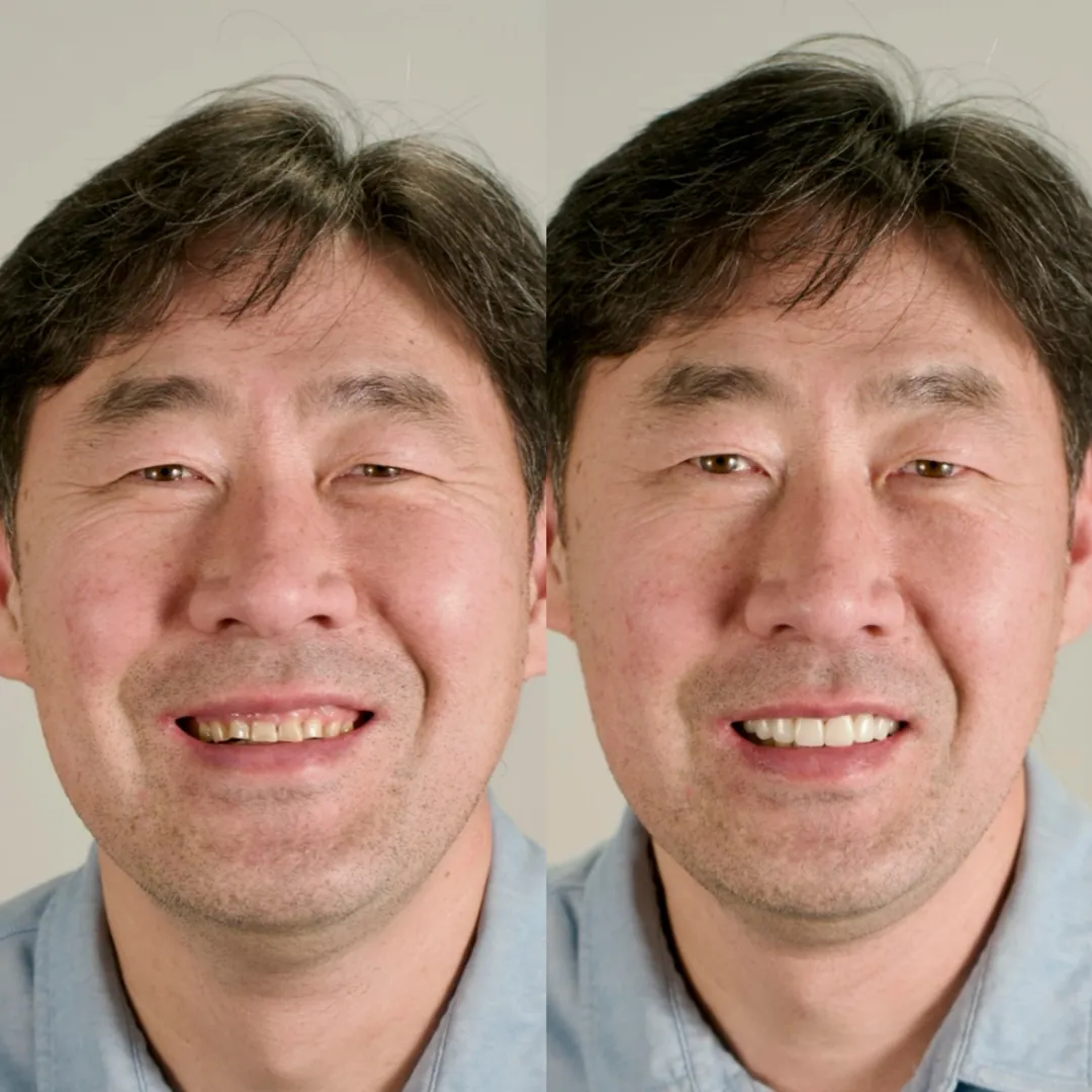 Patient before and with a Smilewear preview