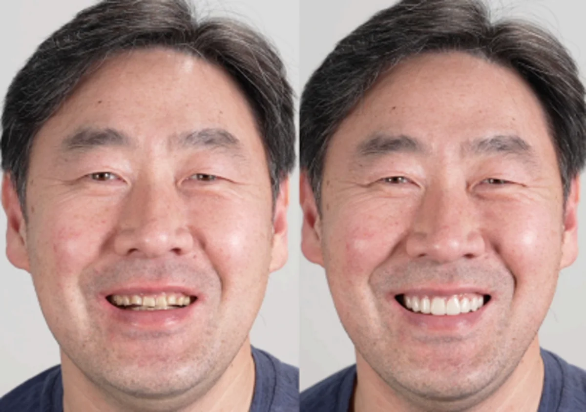 Patient portrait before and while wearing a Smilewear preview