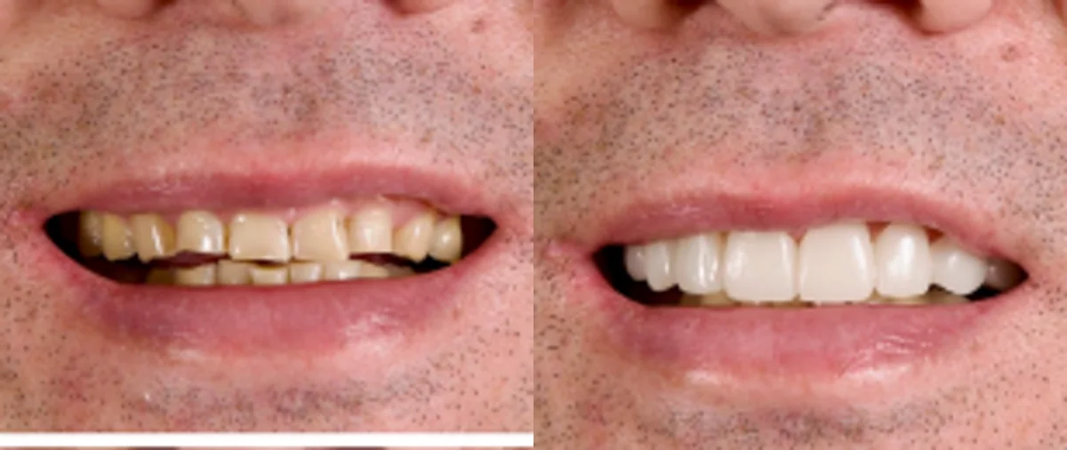 Close view of a smile before and while wearing a Smilewear preview