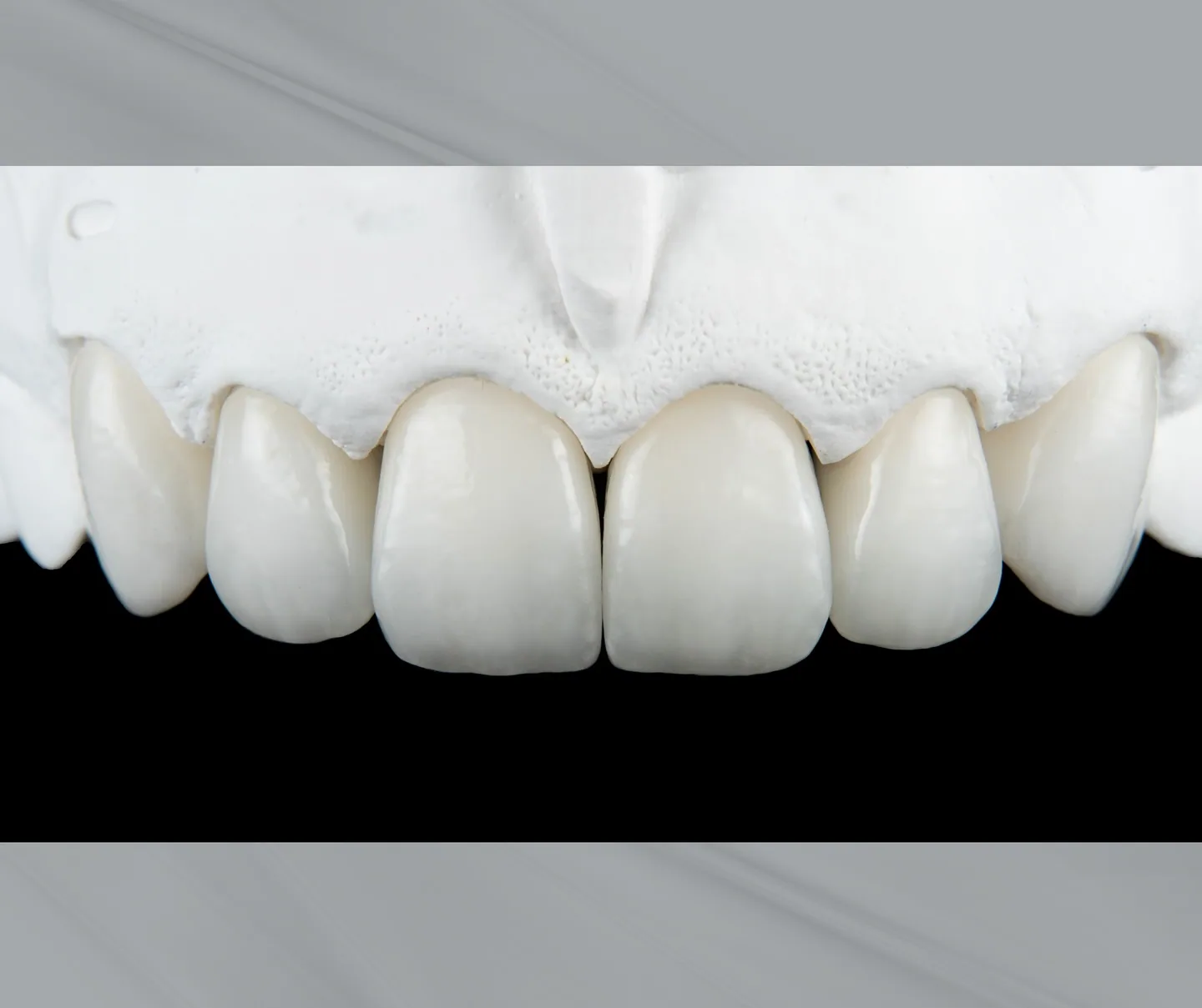 YM Prestige anterior ceramic restoration