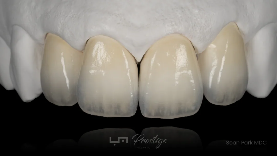 Feldspathic veneers crafted for YM Prestige