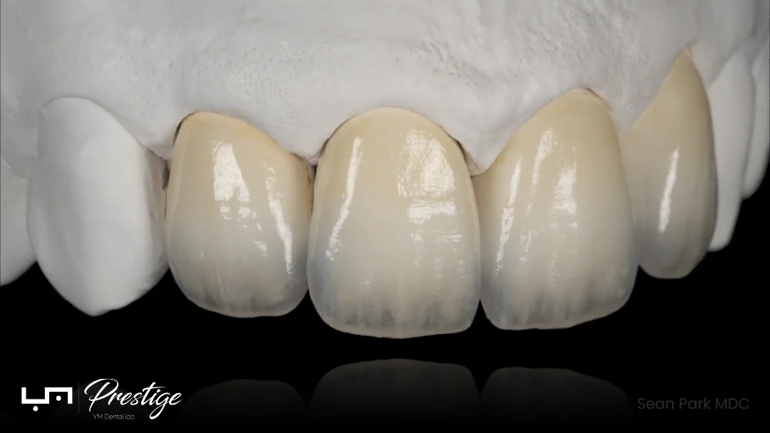 Feldspathic veneer surface detail